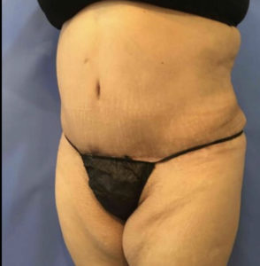 Tummy Tuck Before and After Pictures Washington, DC