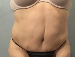 Tummy Tuck Before and After Pictures Washington, DC