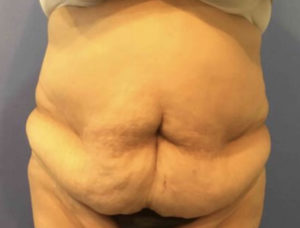 Tummy Tuck Before and After Pictures Washington, DC