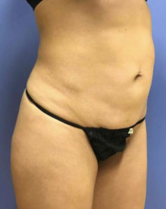 Tummy Tuck Before and After Pictures Washington, DC