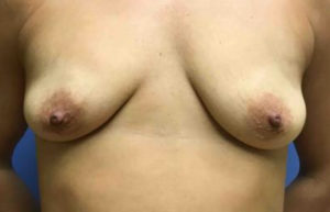 Breast Augmentation Before and After Pictures Washington, DC