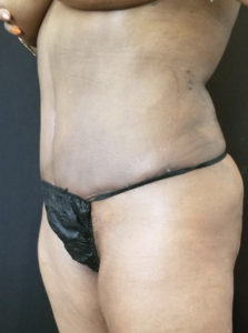 Tummy Tuck Before and After Pictures Washington, DC