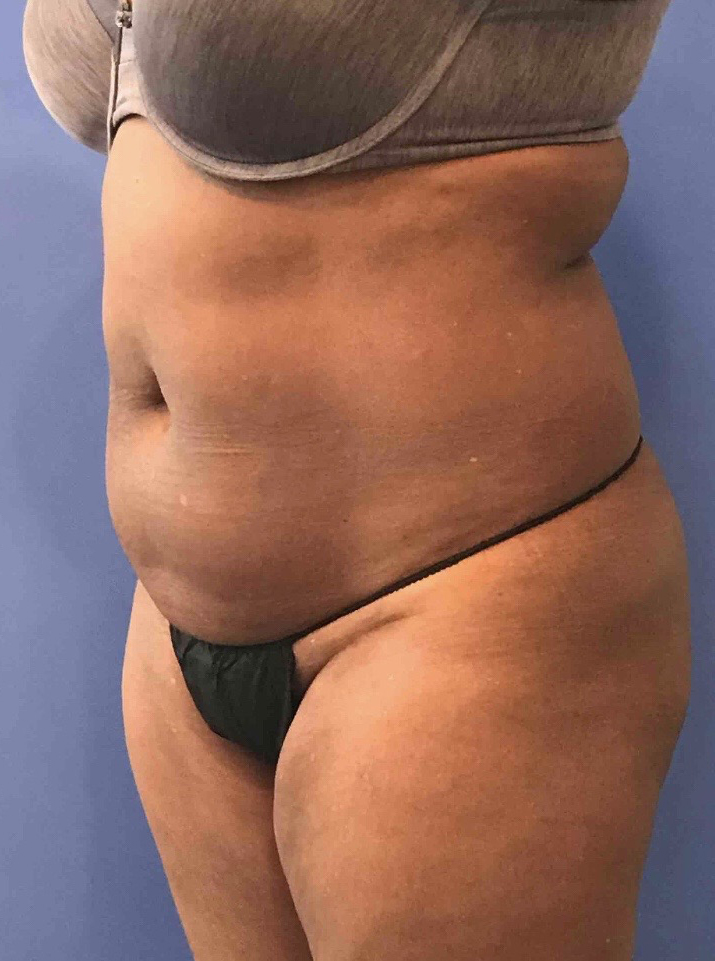 Tummy Tuck Before and After Pictures Washington, DC