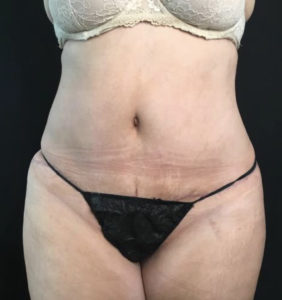 Tummy Tuck Before and After Pictures Washington, DC