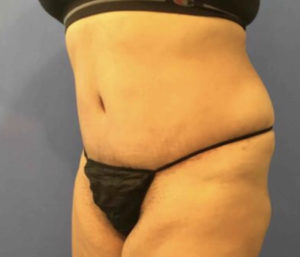 Tummy Tuck Before and After Pictures Washington, DC