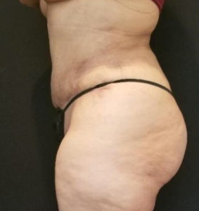 Tummy Tuck Before and After Pictures Washington, DC