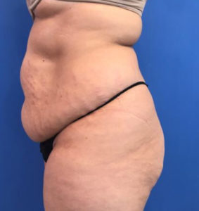 Tummy Tuck Before and After Pictures Washington, DC