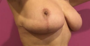 Breast Lift Before and After Pictures Washington, DC