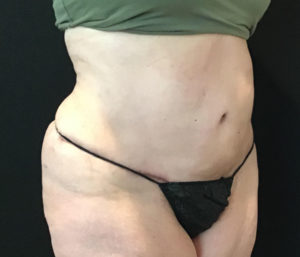 Tummy Tuck Before and After Pictures Washington, DC