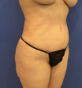 Tummy Tuck Before and After Pictures Washington, DC