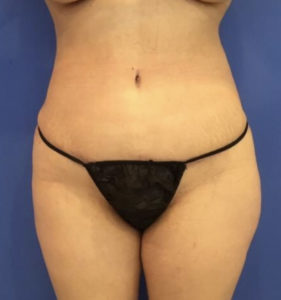 Tummy Tuck Before and After Pictures Washington, DC