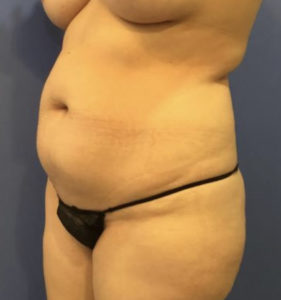 Tummy Tuck Before and After Pictures Washington, DC