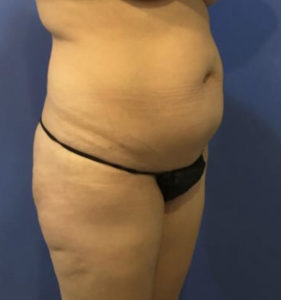 Tummy Tuck Before and After Pictures Washington, DC