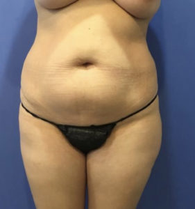 Tummy Tuck Before and After Pictures in Washington, Vienna, VA