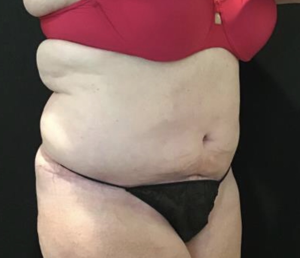 Tummy Tuck Before and After Pictures Washington, DC