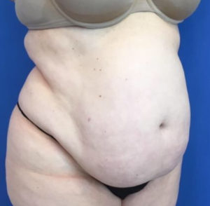 Tummy Tuck Before and After Pictures Washington, DC