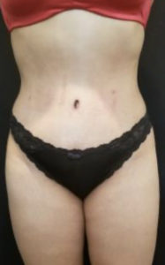 Tummy Tuck Before and After Pictures Washington, DC