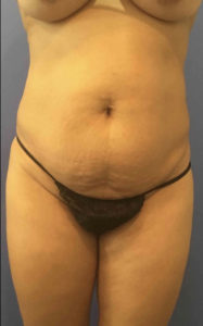 Tummy Tuck Before and After Pictures Washington, DC