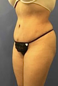 Tummy Tuck Before and After Pictures Washington, DC