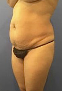 Tummy Tuck Before and After Pictures Washington, DC