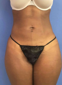 Liposuction Before and After Pictures Washington, DC