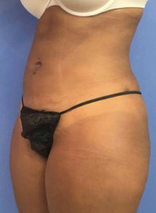 Liposuction Before and After Pictures Washington, DC