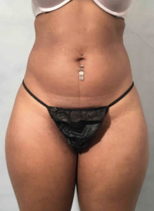 Liposuction Before and After Pictures Washington, DC