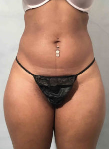 Liposuction Before and After Pictures Washington, DC