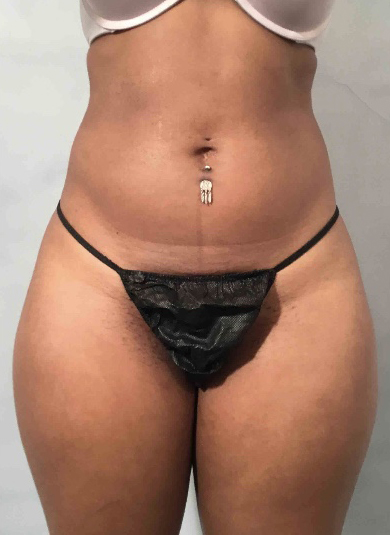 Liposuction Before and After Pictures Washington, DC
