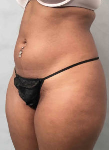 Liposuction Before and After Pictures Washington, DC