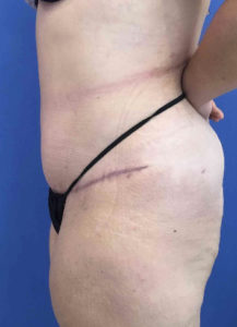 Tummy Tuck Before and After Pictures Washington, DC