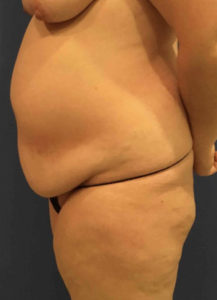 Tummy Tuck Before and After Pictures Washington, DC