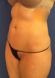 Liposuction Before and After Pictures Washington, DC