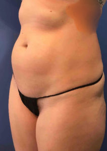 Liposuction Before and After Pictures Washington, DC