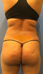 Liposuction Before and After Pictures Washington, DC