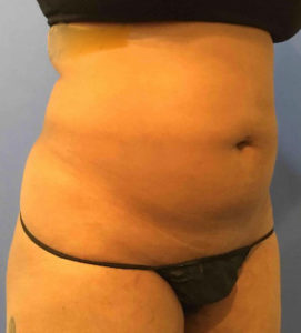 Liposuction Before and After Pictures Washington, DC