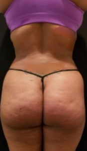 Liposuction Before and After Pictures Washington, DC