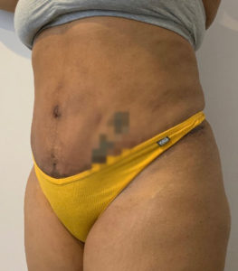 Tummy Tuck Before and After Pictures Washington, DC