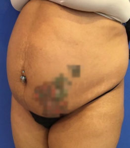 Tummy Tuck Before and After Pictures Washington, DC