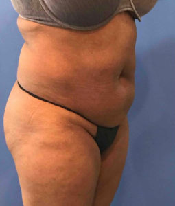 Tummy Tuck Before and After Pictures Washington, DC