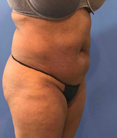 Tummy Tuck Before and After Pictures Washington, DC