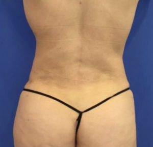 Liposuction Before and After Pictures Washington, DC