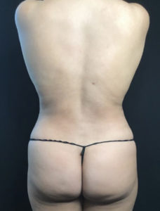 Liposuction Before and After Pictures Washington, DC