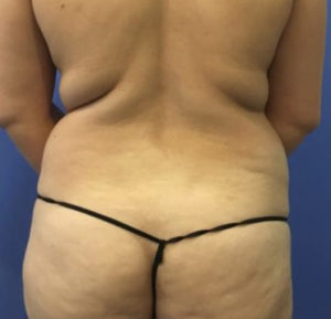 Liposuction Before and After Pictures Washington, DC