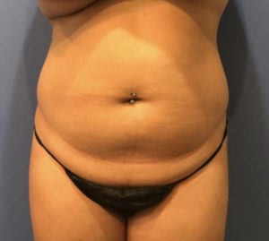 Liposuction Before and After Pictures Washington, DC