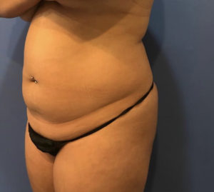 Liposuction Before and After Pictures Washington, DC