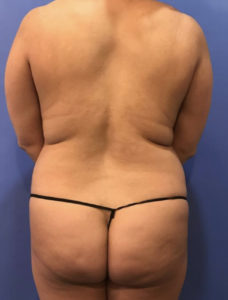 Liposuction Before and After Pictures Washington, DC