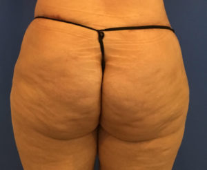 Fat Transfer to Buttocks Before and After Pictures Washington, DC