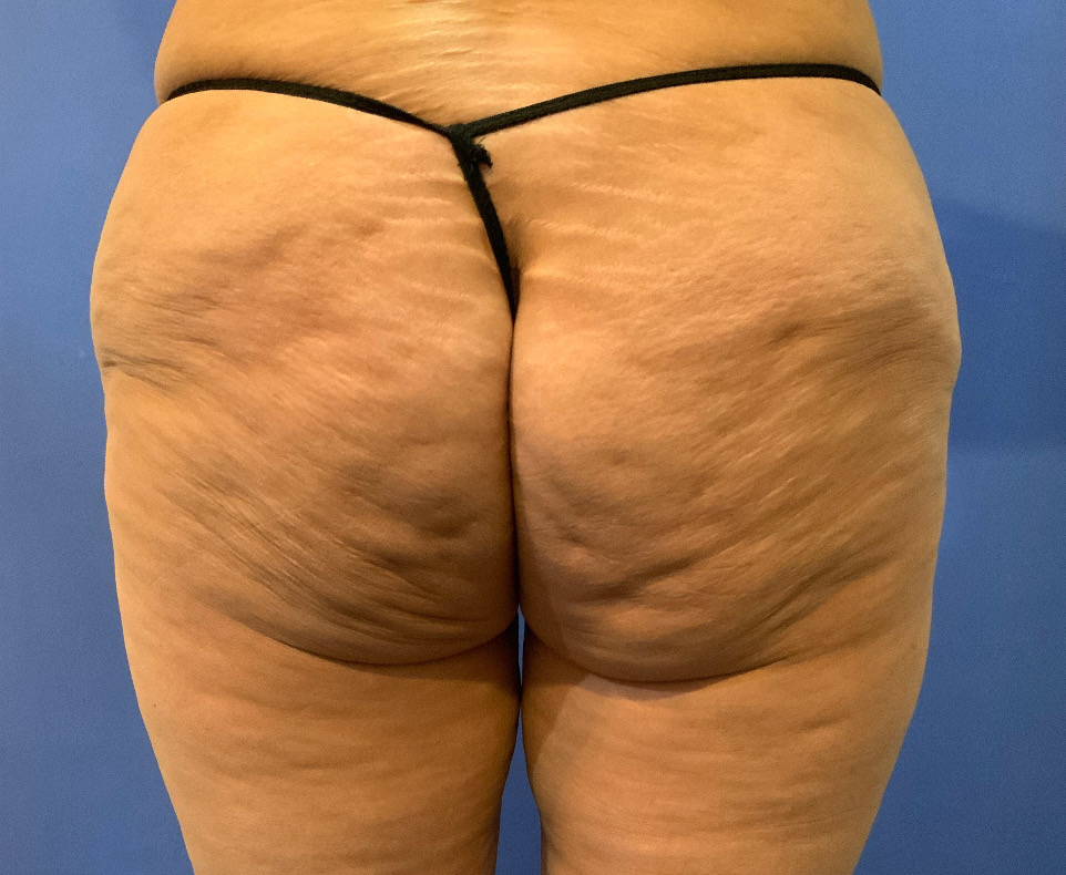 Fat Transfer to Buttocks Before and After Pictures Washington, DC