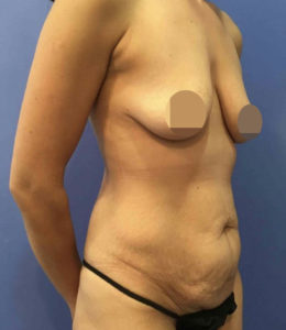 Tummy Tuck Before and After Pictures Washington, DC